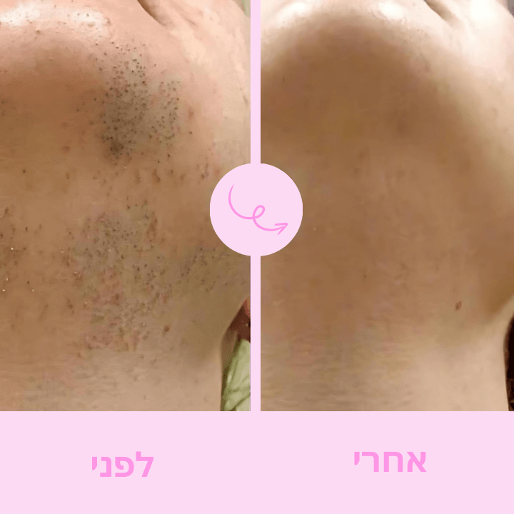 Boonality™ - להסיר שיער בנוחות